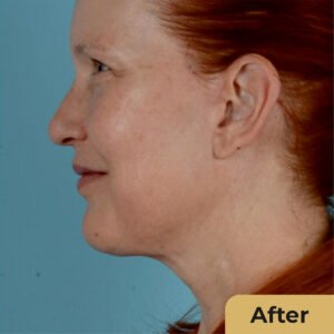 Neck Lift.01