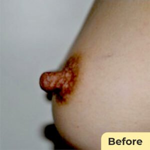 Nipple Reduction 01