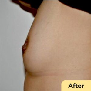 Nipple Reduction 02