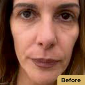 Non Surgical Facelift 01