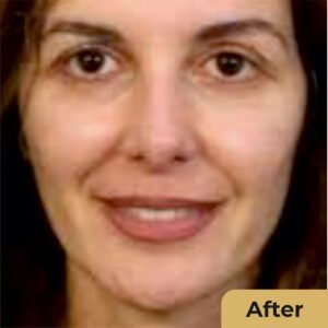 Non Surgical Facelift 02