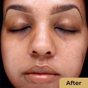 Pigmentation Treatment 02