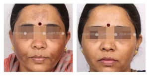 Pigmentation Treatment