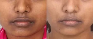 Pigmentation Treatment(1)