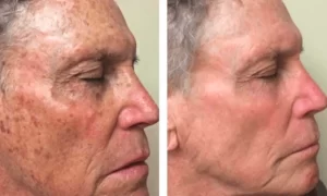 Pigmentation Treatment(2)