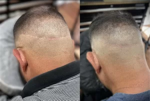 Scalp micropigmentation_