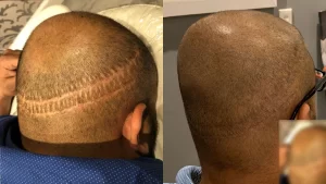 Scalp micropigmentation_(1)