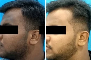 Skin Whitening Treatment