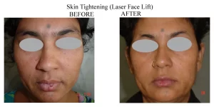 Skin Whitening Treatment(1)