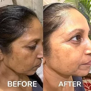 Skin Whitening Treatment(2)