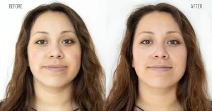 Skin Whitening Treatment(3)