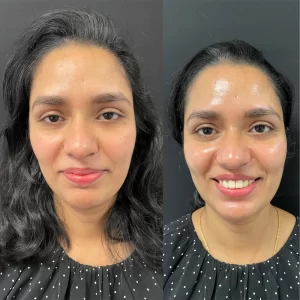 Skin Whitening Treatment(4)