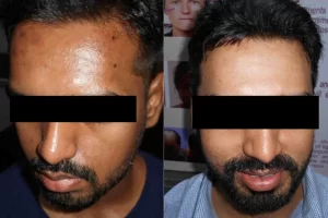 Skin Whitening Treatment(6)