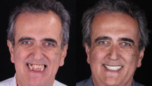 Tarzana-Dental-Implant-before-and-after-1