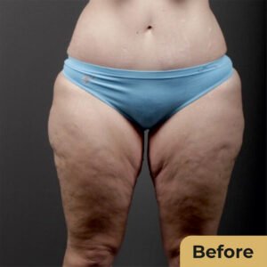 Thigh lift 01