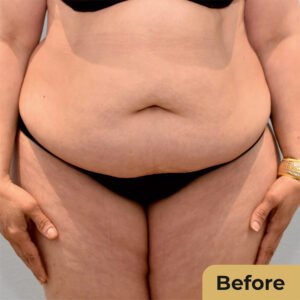 Tummy tuck 01