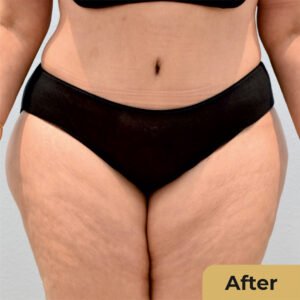 Tummy tuck 02
