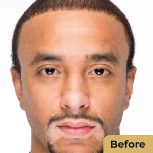 Vitiligo Treatment in Vadodara