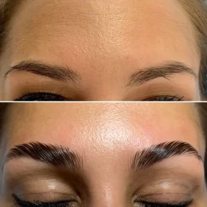 brow lift 2