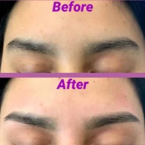 browlift1