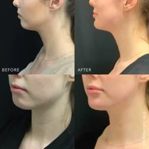 jaw contour(2)