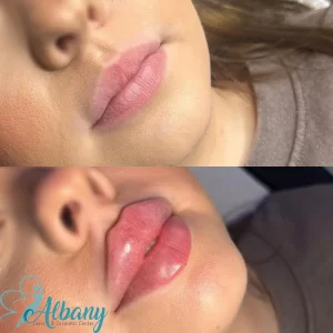 lip contouring