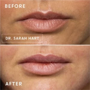 lip contouring(1)
