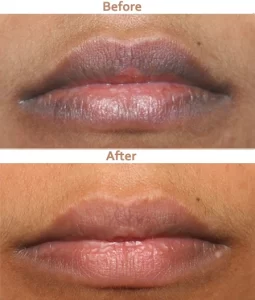 lip contouring(2)