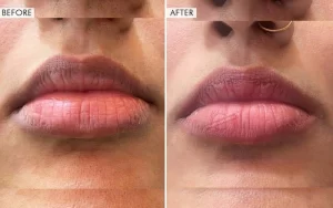 lip contouring(3)