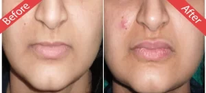 lip contouring(4)