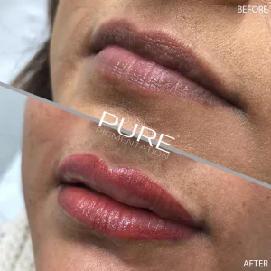 lip contouring(5)
