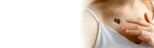 mole, wart, tag removal page