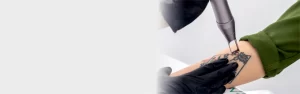 tattoo removal page