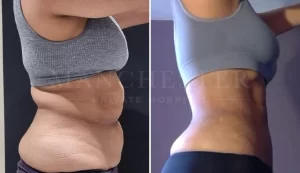 vaser lipo(3)
