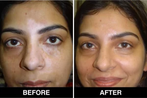 vitiligo