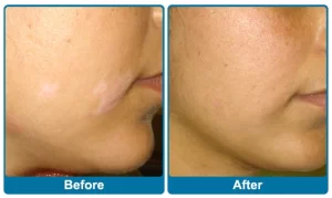 Vitiligo Treatment in Vadodara