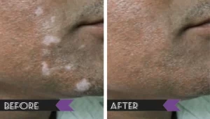 Vitiligo Treatment in Vadodara