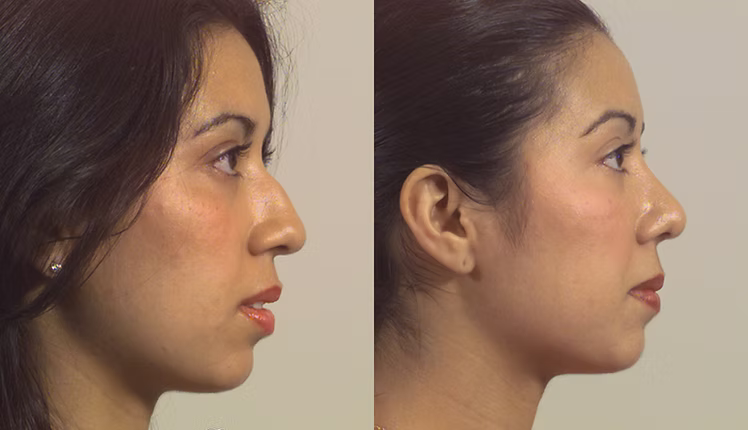 EnglishPlasticAndCosmeticSurgeryCenter-Chin-Augmentation-BeforeAfter-Case8