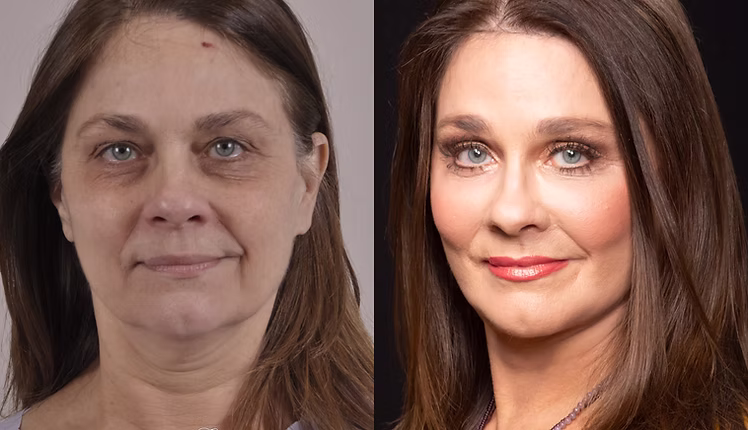 EnglishPlasticAndCosmeticSurgeryCenter-Facelift-BeforeAfter-Case172-3