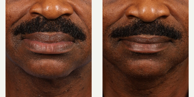 Lip-Reduction-before-2596438-after-2596439-1-2617554