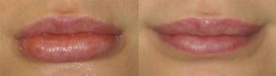 Lip-Reduction-before-795720-after-795721-2-458982