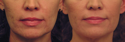 Skin-Tightening-before-2258854-after-2258855-2-53749