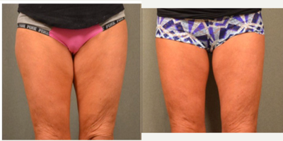 Skin-Tightening-before-3339031-after-3339032-1-6135987