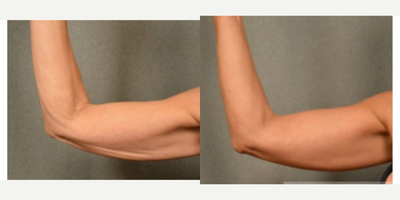 Skin-Tightening-before-3339043-after-3339044-1-6135977