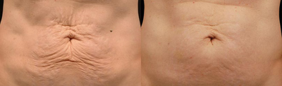 Skin-Tightening-before-4381183-after-4381184-1-9594792