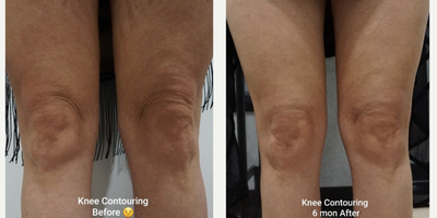 Skin-Tightening-before-5546670-after-5546671-1-12678348