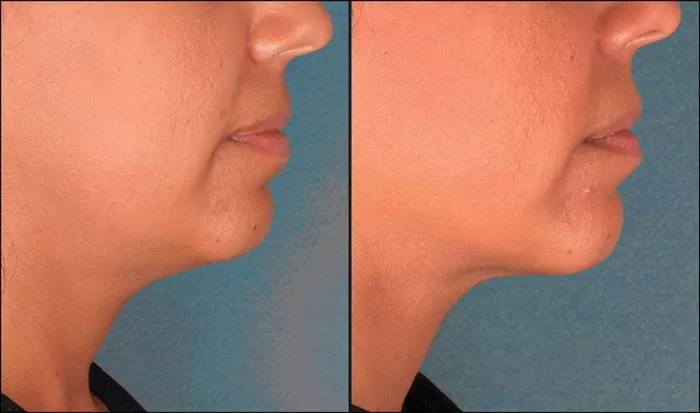 double-chin-reduction-522-view-1-thumbnail