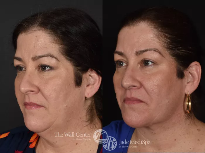 double-chin-reduction-828-left-oblique-thumbnail