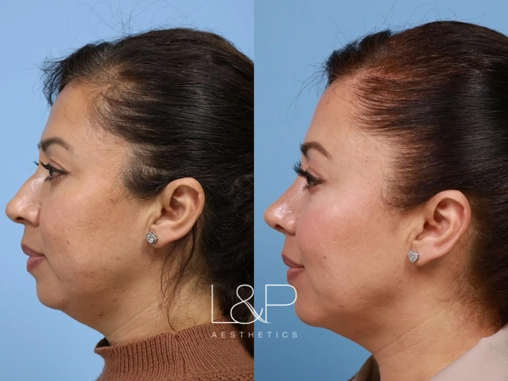 rhinoplasty-297-left-side-detail.jpg.optimal