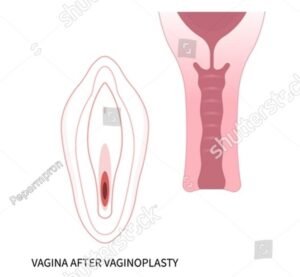 stock-vector-surgery-female-women-vagina-reconstruction-of-minor-vulval-labia-loose-lips-genital-beauty-tighten-2220634197 (1)